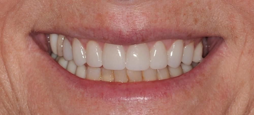 An after photo of a woman smiling with a healthy smile