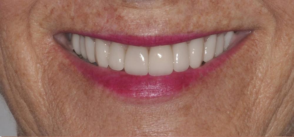 After photo of woman with a cleaned up smile